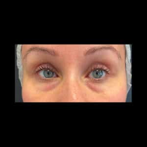 Before Image: Exion Face & RF Microneedling By Jes