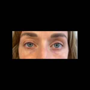 After Image: Tear Trough Filler
