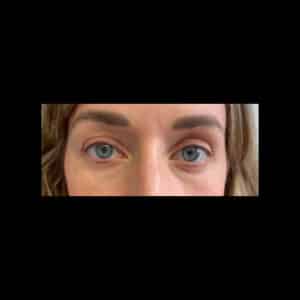 Before Image: Tear Trough Filler