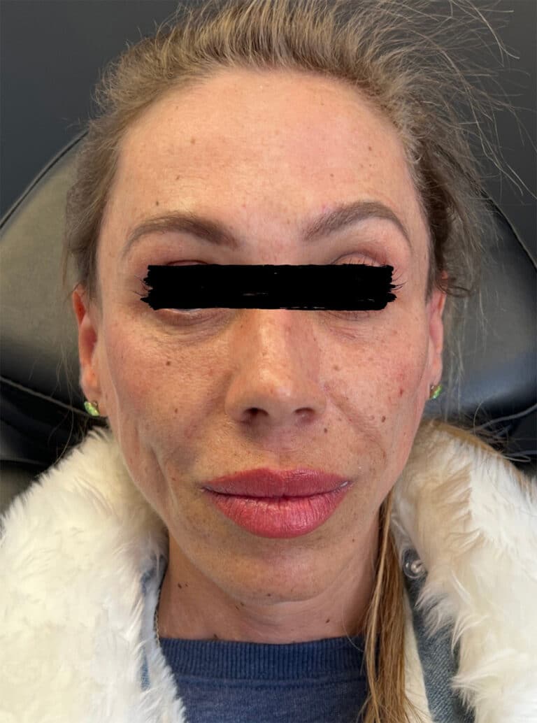 After Image: Cheek Re-Construction – Filler - front