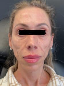 Before Image: Cheek Re-Construction – Filler