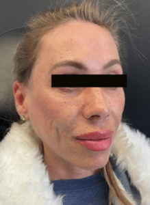 After Image: Cheek Re-Construction – Filler