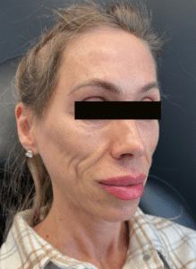 Before Image: Cheek Re-Construction – Filler