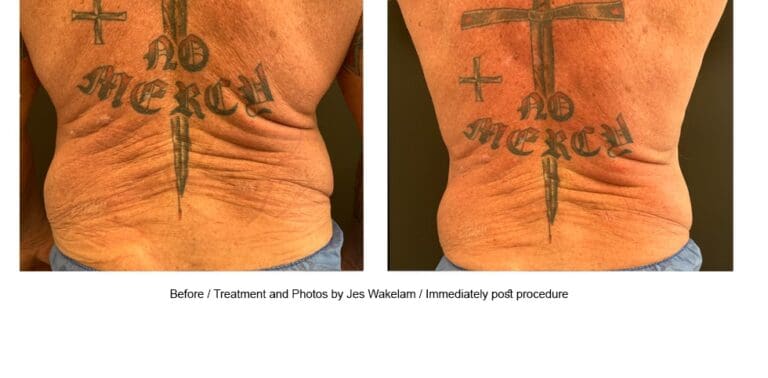 Baseline-12-months-post-treatment